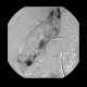 Renal cell carcinoma, RFA, embolization, follow-up: AG - Angiography